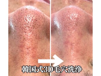 ラウーム 下北沢(lawomb)/韓国式3D毛穴洗浄 Before/After