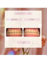 プラスビーセルフ(+b self)/ホワイトニングビフォーアフター
