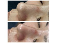 毛穴・ザラツキ・たるみの改善に特化した毛穴専用コースが誕生