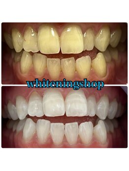 ホワイトニングショップ 武蔵小杉店/【BeforeAfter】12回 施術後比較