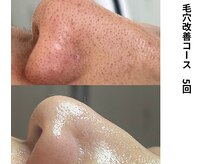 ボニータ(Bonita)/毛穴エクストラクション