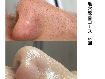 ボニータ(Bonita)/毛穴エクストラクション