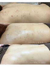 ホリホック/背中のニキビケア