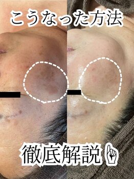 ウィズティ(with.T)/ハーブピーリング