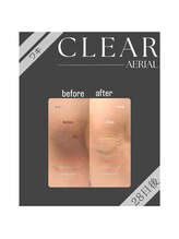 エアリアル 大牟田店/人気の黒ずみケアbefore after