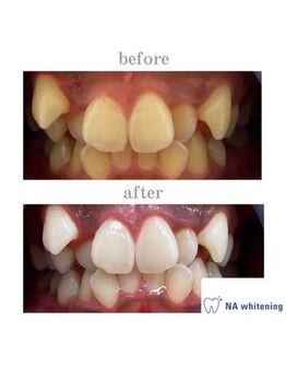 NA ホワイトニング 川崎溝の口店/ホワイトニング/川崎/溝の口