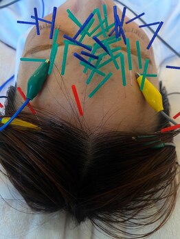 コス(KOS)/美容鍼