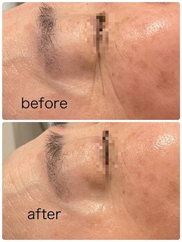 ハッチー(Hacchi)/陶肌トリートメント！