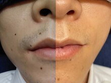 メンズオーシャンブルー/ヒゲ症例2