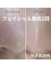 人気NO1★黒ずみ.角栓除去★デープクレンジングエステ90分￥8800→￥6600
