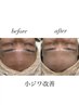【30~40代の本格シワ改善】小ジワをピンっ！ハリ艶肌へ