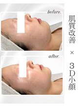 リアム(LiAm)/ララピール×レモンボトル