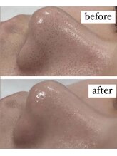 アウラ(AURA)/毛穴洗浄はすごいです！