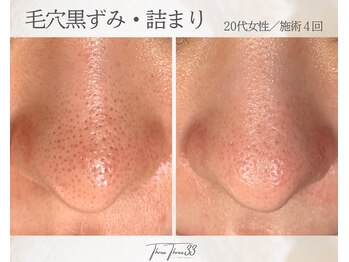 スリースリー(THREE THREE)/毛穴黒ずみ・詰まりケア