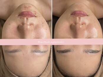 エイプリルフールズ(April fools)/【20代】ニキビケアで美肌へ！