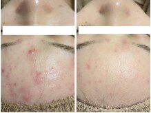 アン(anne)の雰囲気（ハーブピーリング♪ニキビ・毛穴ケア/くすみ/乾燥に優しいハーブ）