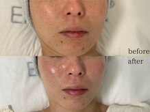 ステラ(Stella)/ハーブピーリングで艶肌