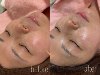 カノネ(Cannone')/シミ / 美白 施術1回