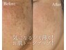 【しみしわくすみケア】肌質改善プラズマフェイシャル¥12000