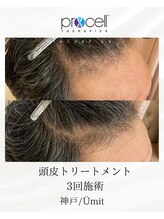 ユミト(Umit)/プロセルスカルプ