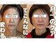 ラトビア(Latvia)の写真/九州ごく僅か【小顔リフト専門】たるみ改善には土台の骨から引き上げるのがコツ◎小顔矯正￥15000が45%OFF