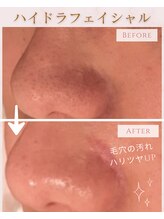 ココロ(COCORO)/ハイドラ　ビフォーアフター