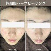 毛穴・ニキビケア・肌ケア専門ハーブピーリングサロンSkin Baby 新橋