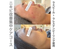 ギャラント(GALLANT)の雰囲気（もう隠さなくていい！繰り返すニキビ凹凸肌も自分史上最高の肌へ）