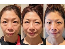 2回で劇的変化！回数を重ねる毎にリフトアップ。肌質改善も。