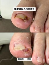 巻き爪じゅん 千葉駅前店/陥入爪の痛みに向き合う一日