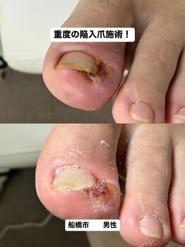 巻き爪じゅん 千葉駅前店/陥入爪の痛みに向き合う一日