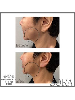 ソラ 天神 大名(SORA)/切らないリフト1回60kj