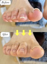 ニコワイズネイル(Nico Y's Nail)/【巻き爪緩和コース】