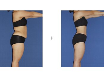 Nビューティー/最新エンダモロジーBODY