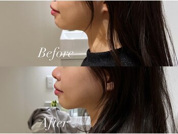 ハクト(Hakuto)/Before/After