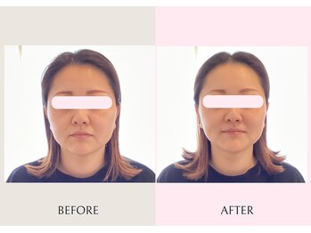 サン(SUN)/小顔矯正before/after