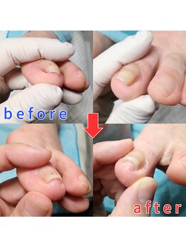 【巻き爪】ネイル/フット