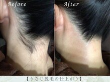 サラリ ビューティー ラウンジ(Sarari BEAUTY LOUNGE)/うなじ脱毛！首周りがスッキリ！
