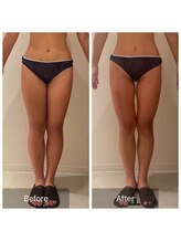 ルナスーリヤ 表参道店/痩身before　after