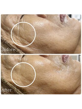 エース(ACE.)/目尻のシワ改善!!