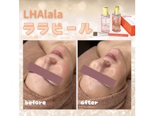 リノア 調布(Li'noa)の雰囲気（ダウンタイム無！肌質改善/美白/韓国発ララピールお試し下さい◎）
