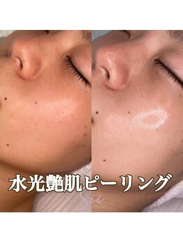 ラウーム 下北沢(lawomb)/水光艶肌ピーリングBefore/After