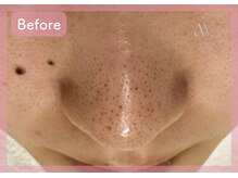 ミリ(mili)/鼻の黒ずみを改善