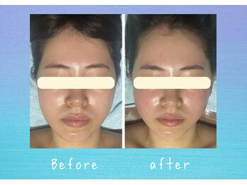 マタハリ(Matahari)/小顔コルギでむくみスッキリ!