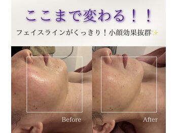 ユフラ(Juhla)/切らない小顔リフトサーマル