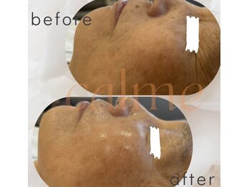 メゾン カルム 天文館店(MAISON CALME)/肌質改善