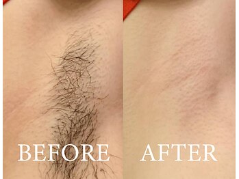 ラヴァコケット 梅田店(Lova'coquette)/一度でスッキリツルツルに