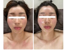 武蔵小杉リンパサロン かおりの部屋/小顔筋膜リリース