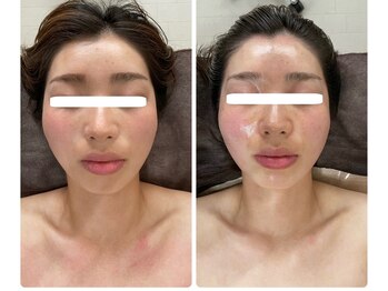 武蔵小杉リンパサロン かおりの部屋/小顔筋膜リリース