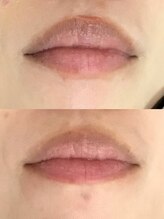 ドクターメラニン ラボ トーキョー 渋谷(Dr. Melanin Labo TOKYO)/唇メラニンケア症例
